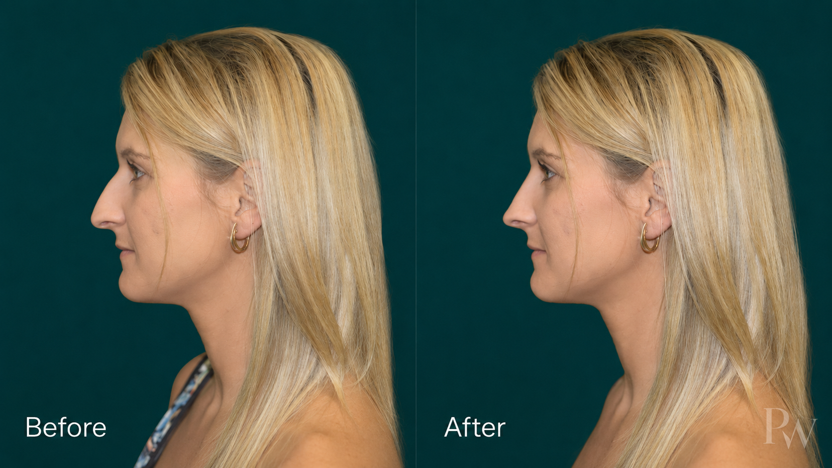 Rhinoplasty before and after 3