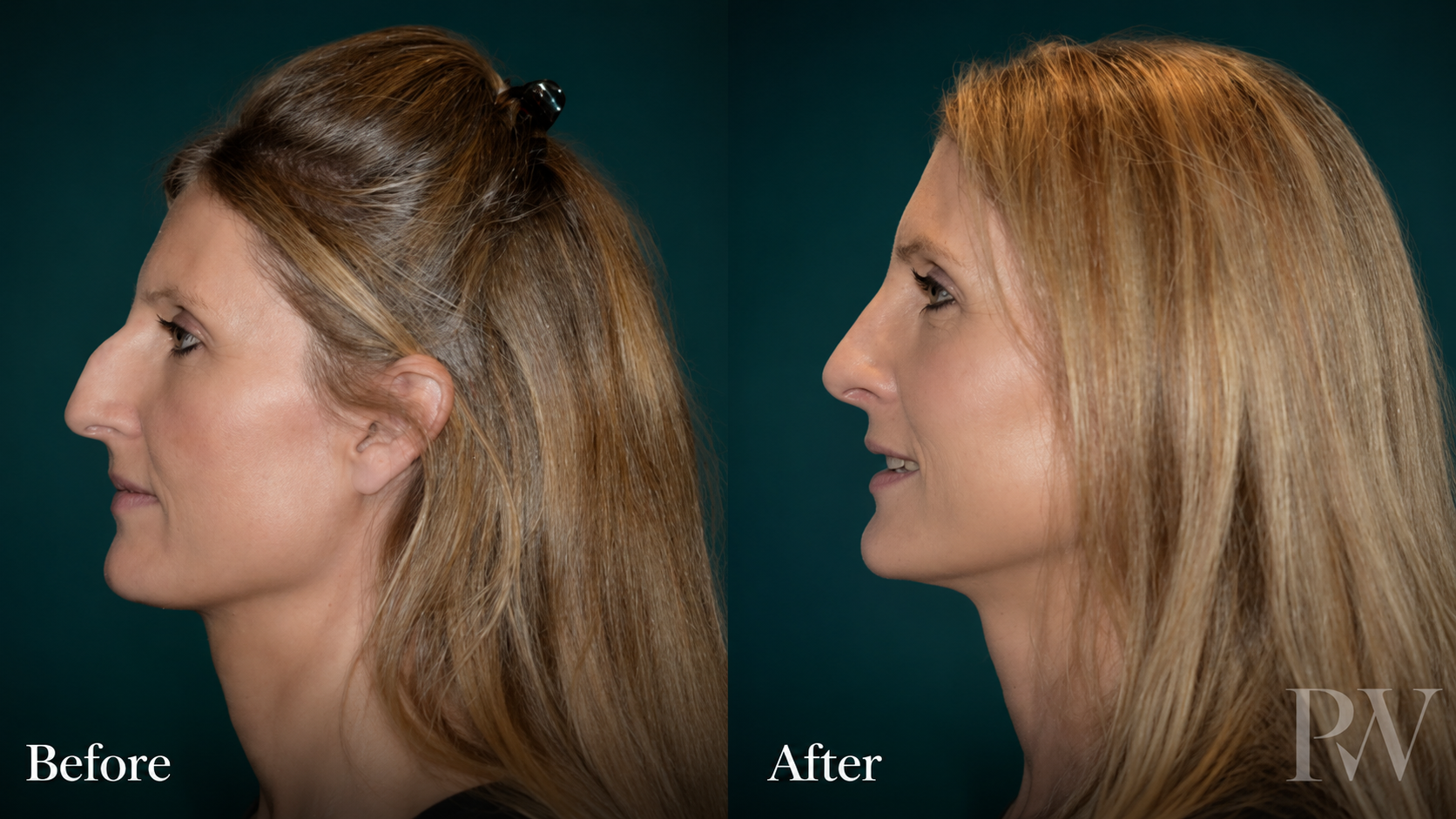 Rhinoplasty before and after 1