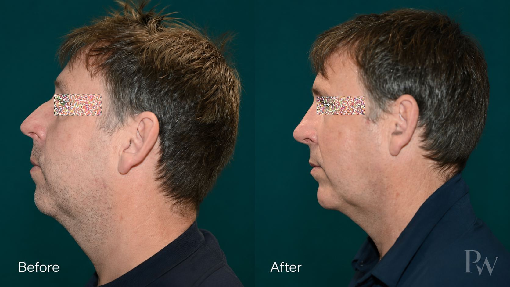 Rhinoplasty before and after 2